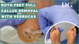 Callus removal from feet both feet and three verruca plantar warts treatment [upl. by Nahtnanhoj]