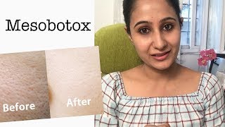 Mesobotox for open pores and smoother skinमेसो बॉटॉक्स [upl. by Siger]