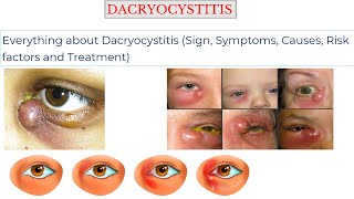 DACRYOCYSTITIS Sign Symptoms Causes Risk factors Treatment [upl. by Inanuah]