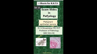 Exam slides Malignant epithelial lesionsDr GSS SRM MCH RC [upl. by Saturday151]