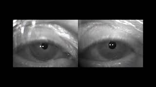 Eye motor abnormalities in Wernicke encephalopathy case 2 [upl. by Mitchel]