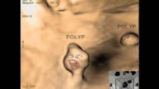 virtual colonoscopythe singing polyps  Dr Israel Shapiro [upl. by Aenit]