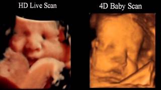 Baby scanning HD Live Scan Versus 4D Baby Scan [upl. by Seagraves569]