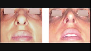 Rhinoplastie Maroc  Chirurgie esthétique et médecine esthétique du nez Clinique IRAQI desthétique [upl. by Haven240]