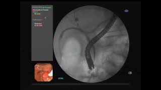 ERCP treatment Bile leakage after cholecystectomy [upl. by Ahsiemac]