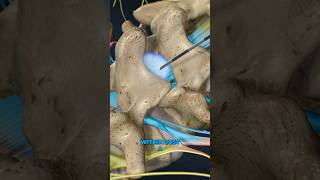 Lumbar Epidural Steroid Injection 3D Animation [upl. by Raquel]