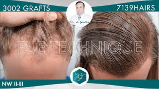 Hair Graft Technique FUE 3002 Grafts 7139 Hairs  Dr de Freitas [upl. by Annenn]