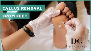 Callus removal from feet balls of feet [upl. by Aiasi]