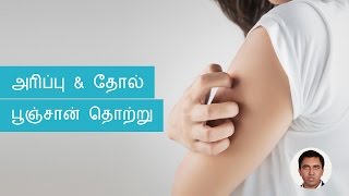 Skin Fungal Infections Symptoms Causes Treatments  Tamil [upl. by Alesandrini565]