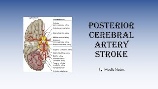 Posterior cerebral artery stroke  causes signs and symptoms investigations treatment [upl. by Bouchier]