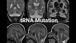 Pontocerebellar hypoplasia and tRNA mutation [upl. by Firahs]