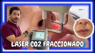 Láser CO2 para eliminar cicatrices  JavierDerma PielSana Dermedica [upl. by Anivlac]