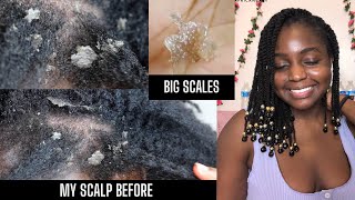 How I cleared Seborrheic Dermatitis amp Healed my scalp NOT SPONSORED  Giveaway [upl. by Adnolaj]