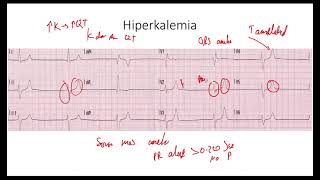 Hiperkalemia EKG [upl. by Ahtanoj]