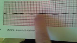 Agonal and Asystole [upl. by Takashi454]