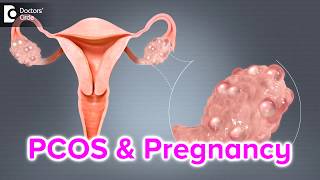 What happens if I have PCOS and I get pregnant  Dr Bala R [upl. by Nela]