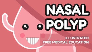 What is Nasal Polyp [upl. by Alaj632]