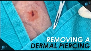 Getting a DERMAL PIERCING removed by a plastic surgeon [upl. by Nissa401]