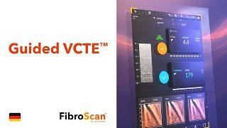 Guided VCTE™  FibroScan® [upl. by Wallford152]