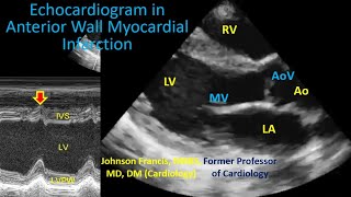 Echocardiogram in Anterior Wall Infarction [upl. by Assiruam]