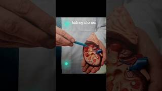 Kidney stones [upl. by Ariahaj358]