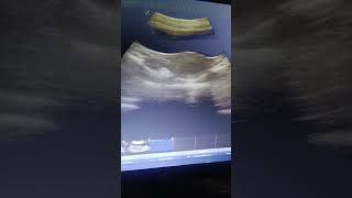 Early pregnancy GS Gastational sac Ovary Ovaries Uterus uterine cavity USG ultrasound PID [upl. by Kcajyllib]