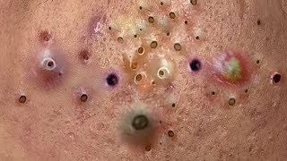 blackheads new 2023  popping pimple  acne and whiteheads removal [upl. by Falkner482]