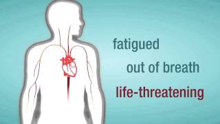 Valve Regurgitation When a Heart Valve Leaks [upl. by Nelav]