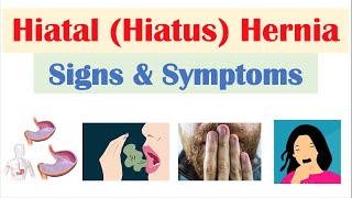 Hiatal Hiatus Hernia Signs amp Symptoms amp Why They Occur [upl. by Giovanna952]