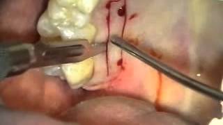 Periodontal Microsurgery Gingival Grafting [upl. by Nera]