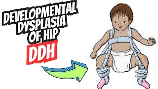 Developmental Dysplasia of the Hip DDH  Diagnosis and Treatment [upl. by Ahsetel]