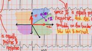 CRASH 2017 EKGs [upl. by Ettevroc495]