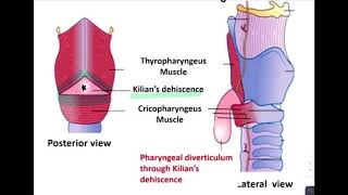 ESOPHAGEAL DIVERTICULUM [upl. by Catt]