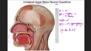 Unilateral Upper Motor Neuron Dysarthria  example and tutorial [upl. by Seugram]