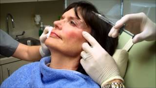 Birminghams Age Defying Facial Lift with Juvederm VOLUMA [upl. by Shulman704]