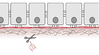 Effects of proteinases with metalloproteinase domains MMPs ADAMs on tumour progression [upl. by Sadonia]