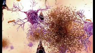 Transforming skin cells from patients with Alzheimer’s into brain cells for studies and treatments [upl. by Atinal]