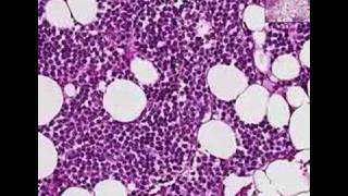 Histopathology BoneMultiple myeloma [upl. by Collete]