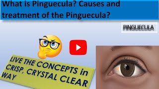 What is Pinguecula  What is the Causes of Pinguecula and the treatment of the Pinguecula [upl. by Rosol250]