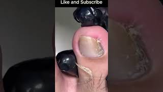 Satisfying Ingrown Toenail Removal in Seconds 👣✨ ingrown [upl. by Lilith]