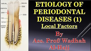 7 Etiology of periodontal diseases1Local factorsDr Wadhah Periodontology lecturesدوضاح الحاج [upl. by Anived]