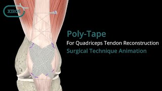 PolyTape for Quadriceps Tendon Reconstruction Surgical Technique Animation [upl. by Lesser]