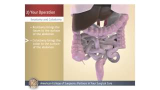 ColostomyIleostomy Your Operation [upl. by Clive]