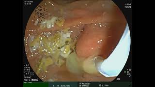 Choledocholithiasis amp Suppurative cholangitis [upl. by Sirroned]