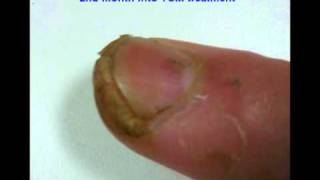 How to get rid of Fingernail Warts 灰趾甲 3 [upl. by Rhyner]