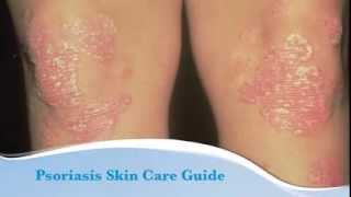 Psoriasis skin care guide [upl. by Prisilla]