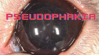 Pseudophakia  Artephakia  Ophthalmology Lecture [upl. by Meeka397]