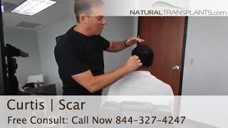 Real Hair Transplant Scar Surgeon Can’t Find It  Dr Siegel Curtis [upl. by Molahs]