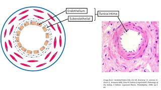 Hyaline arteriolosclerosis [upl. by Akinaj302]