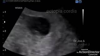 Ectopia cordis ultrasound video 8 weeks fetus [upl. by Rowell]